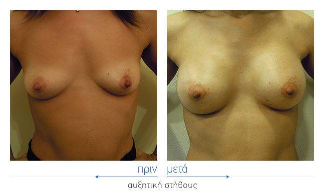 Breast Augmentatntion Before and After