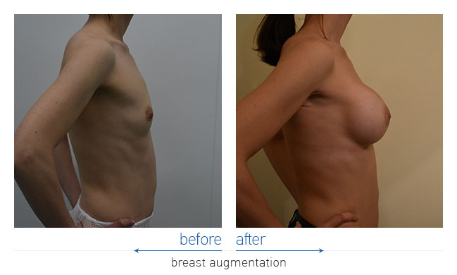 Breast Augmentatntion Before and After