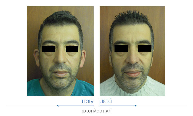 Otoplasty Before and After