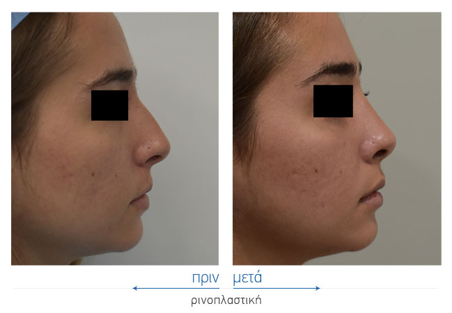 Rhinoplasty Before and After